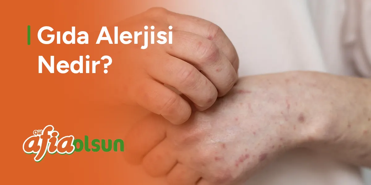 gida-alerjisi-nedir